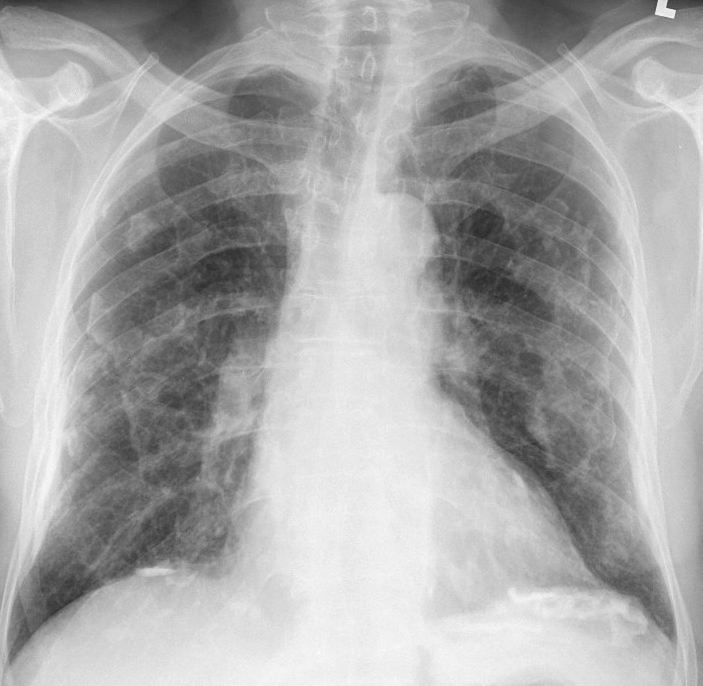 imagine cu fibroza pulmonara